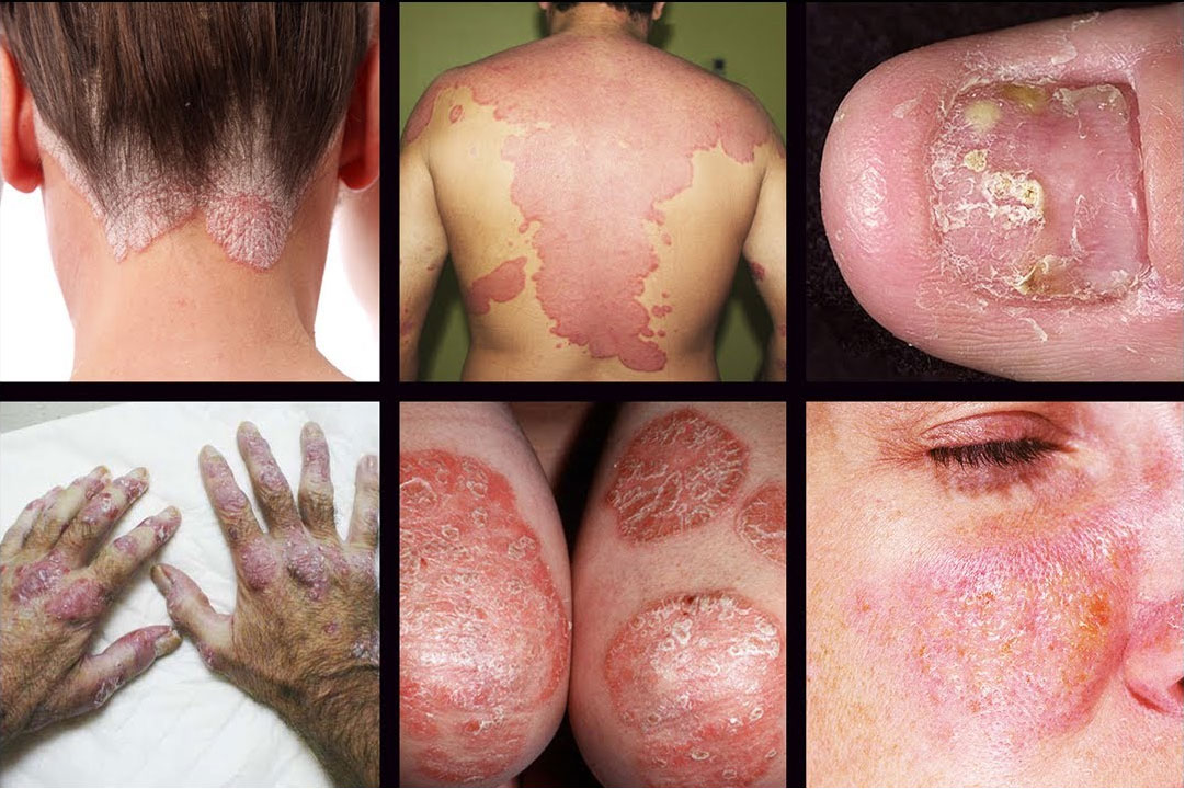 Types-of-Psoriasis