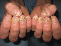 nail fungal