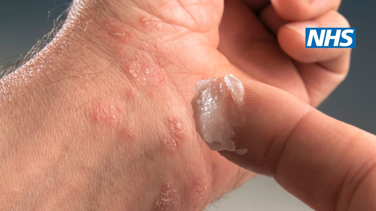 psoriasis