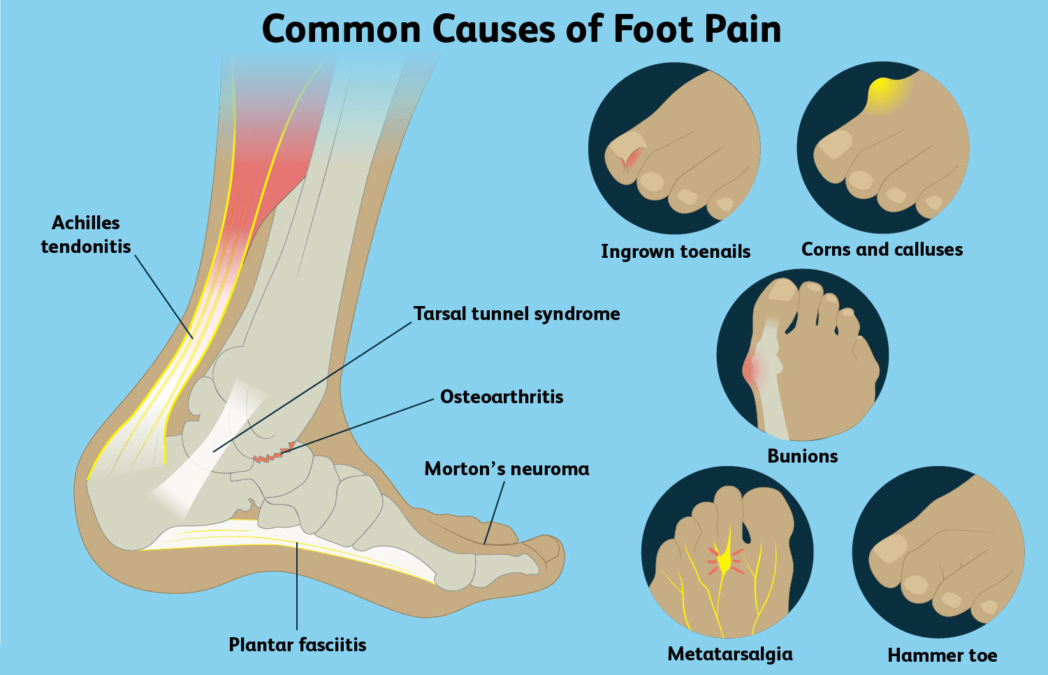 How different shoes causes different problems. TRUCURE